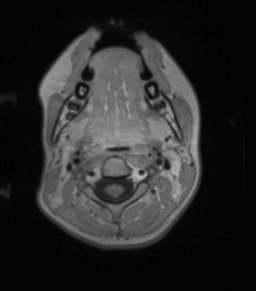 File:Choroid plexus carcinoma (Radiopaedia 91013-108553 Axial T1 C+ 38).jpg