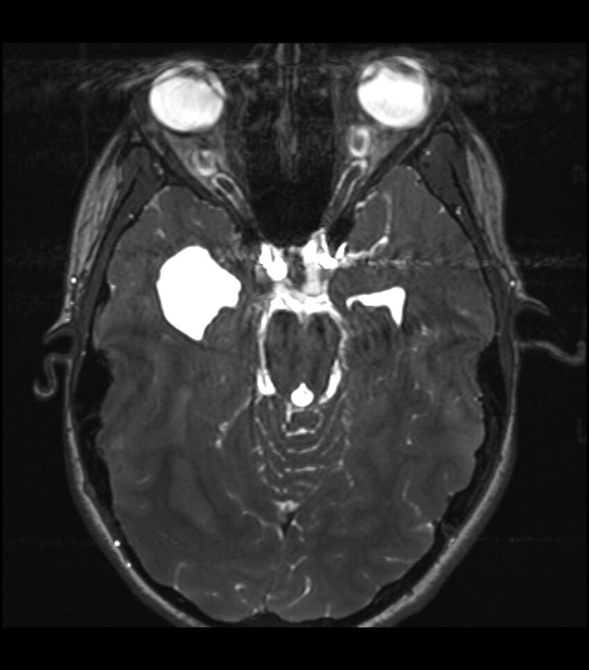 Choroid plexus carcinoma (Radiopaedia 91013-108553 Axial T2 CISS 12).jpg