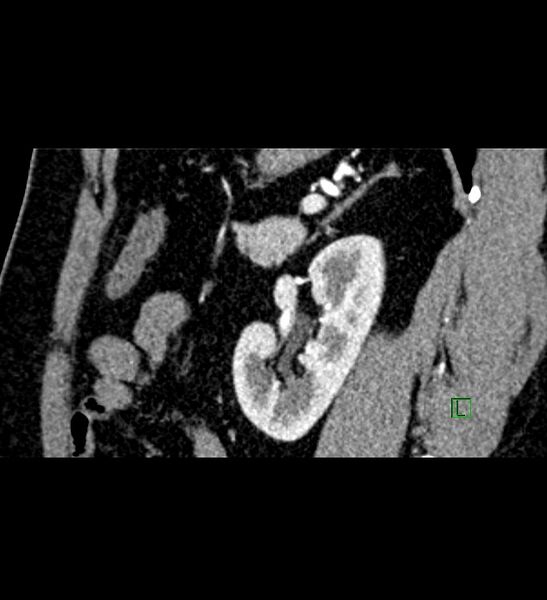 File:Chromophobe renal cell carcinoma (Radiopaedia 84286-99573 F 51).jpg