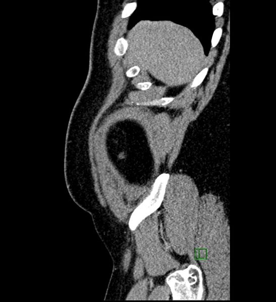File:Chromophobe renal cell carcinoma (Radiopaedia 84286-99573 I 176).jpg