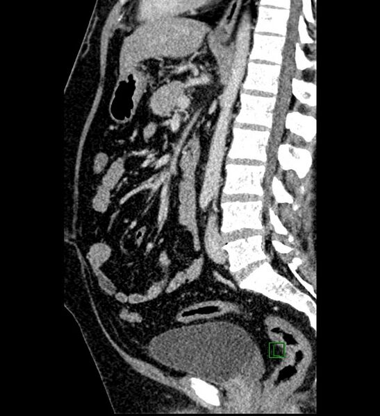 File:Chromophobe renal cell carcinoma (Radiopaedia 84286-99573 I 88).jpg