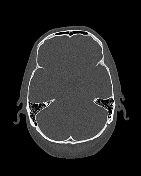 File:Chronic maxillary sinusitis caused by a foreign body (Radiopaedia 58521-65676 Axial bone window 286).jpg