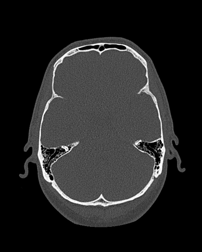 Chronic maxillary sinusitis caused by a foreign body (Radiopaedia 58521-65676 Axial bone window 286).jpg