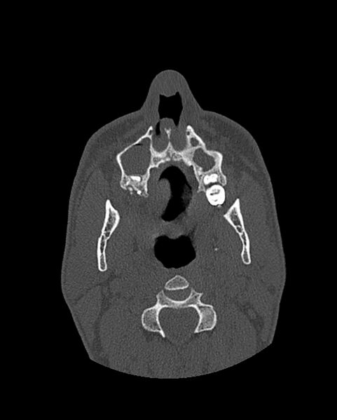 File:Chronic maxillary sinusitis caused by a foreign body (Radiopaedia 58521-65676 Axial bone window 56).jpg