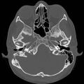 Chronic otomastoiditis (Radiopaedia 27138-27309 Axial bone window 26).jpg