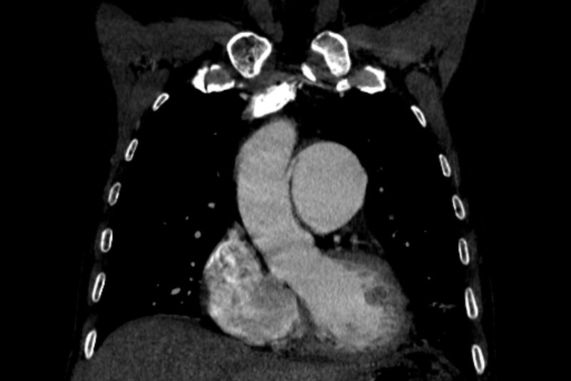 File:Chronic pulmonary embolism with bubbly consolidation (Radiopaedia 91248-108850 B 47).jpg