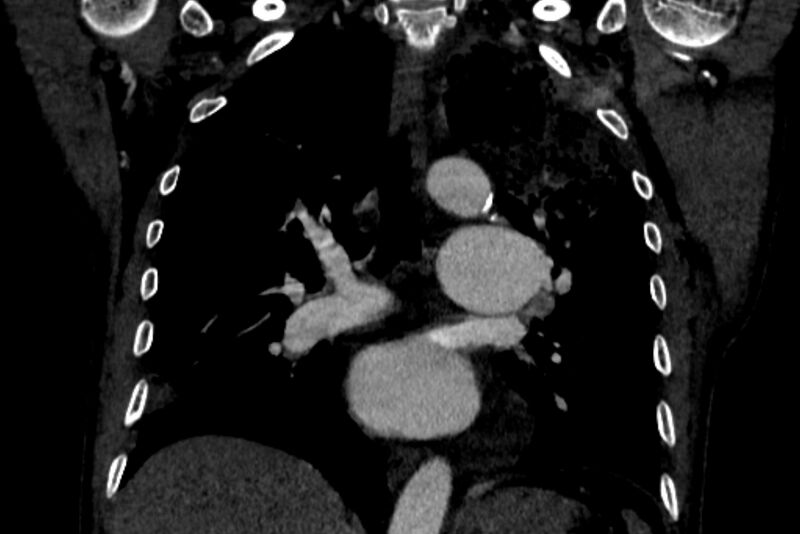 File:Chronic pulmonary embolism with bubbly consolidation (Radiopaedia 91248-108850 B 80).jpg