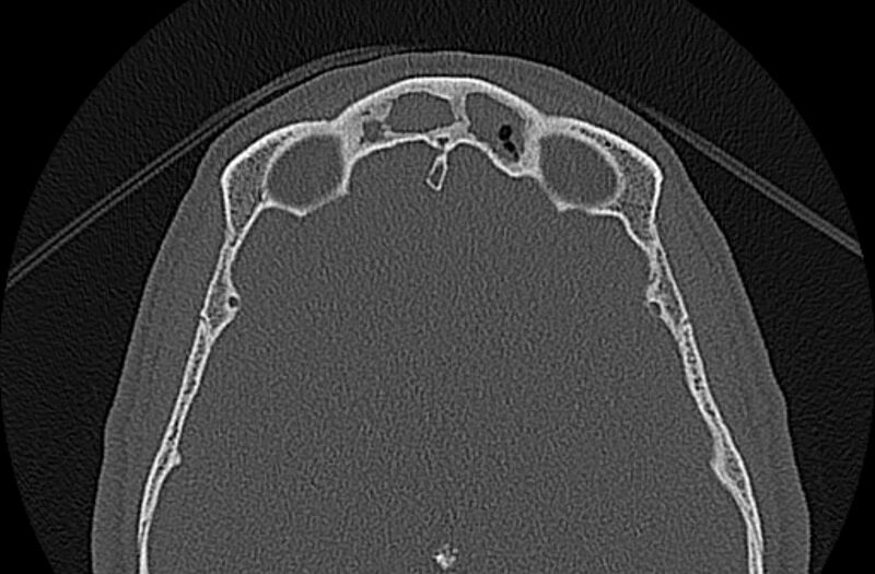 File:Chronic rhinosinusitis (Radiopaedia 65079-74075 Axial bone window 73).jpg