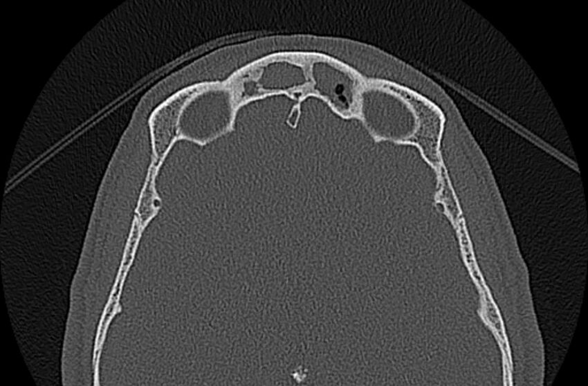 Chronic rhinosinusitis (Radiopaedia 65079-74075 Axial bone window 73).jpg