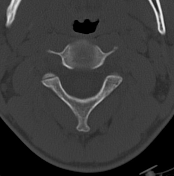 File:Cleft of the posterior arch of C1 mimicking fracture (Radiopaedia 40201-42721 Axial bone window 6).jpg