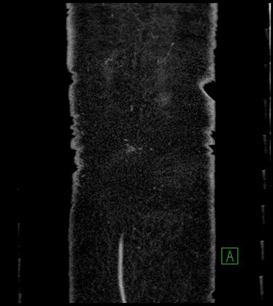 File:Closed-loop small bowel obstruction-internal hernia (Radiopaedia 78439-91096 Coronal non-contrast 102).jpg