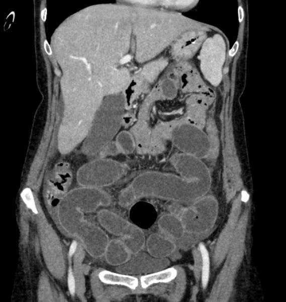 File:Closed loop small bowel obstruction (Radiopaedia 71211-81508 B 30).jpg