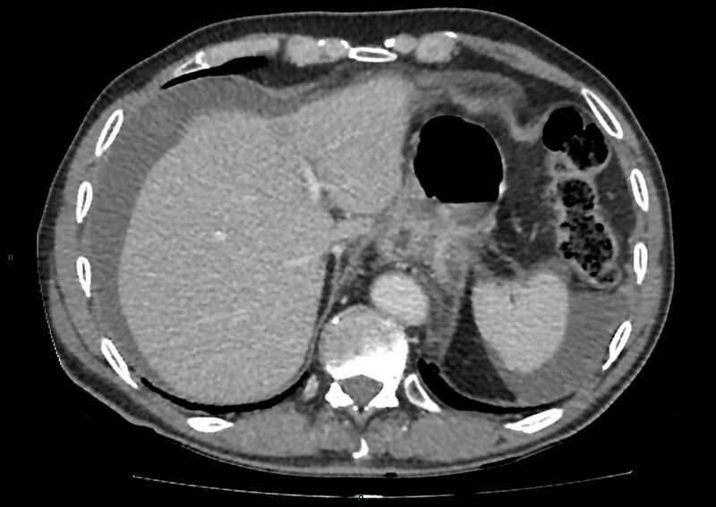 File:Closed loop small bowel obstruction with ischemia (Radiopaedia 84180-99456 A 19).jpg