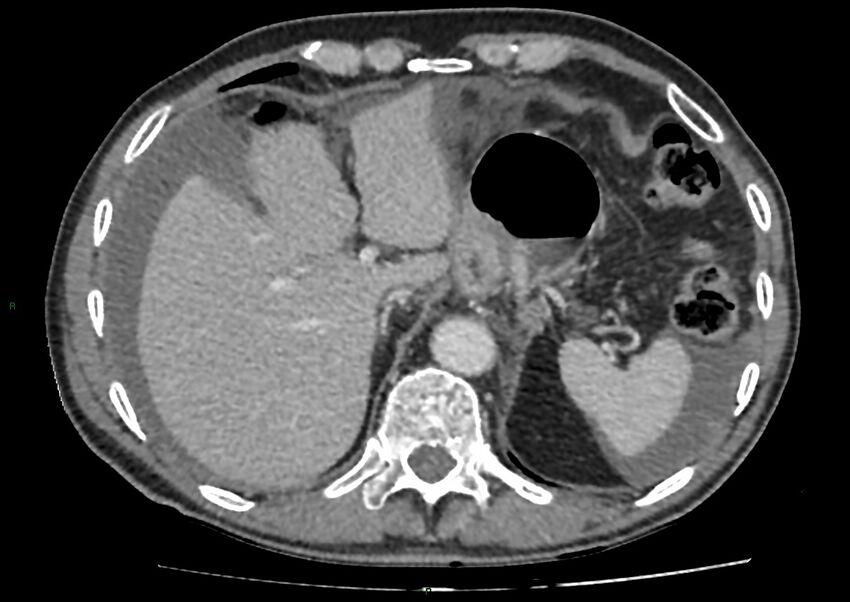 Closed loop small bowel obstruction with ischemia (Radiopaedia 84180-99456 A 22).jpg
