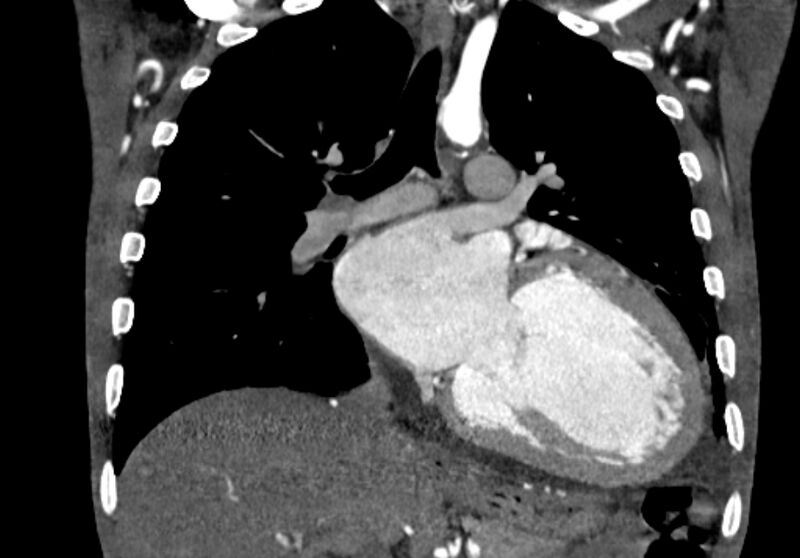 File:Coarctation of aorta with aortic valve stenosis (Radiopaedia 70463-80574 C 124).jpg