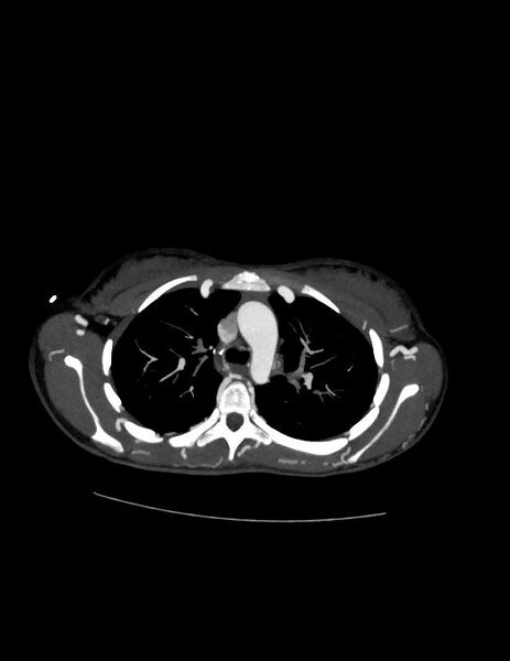 File:Coarctation of the aorta (Radiopaedia 27458-27657 D 9).jpg