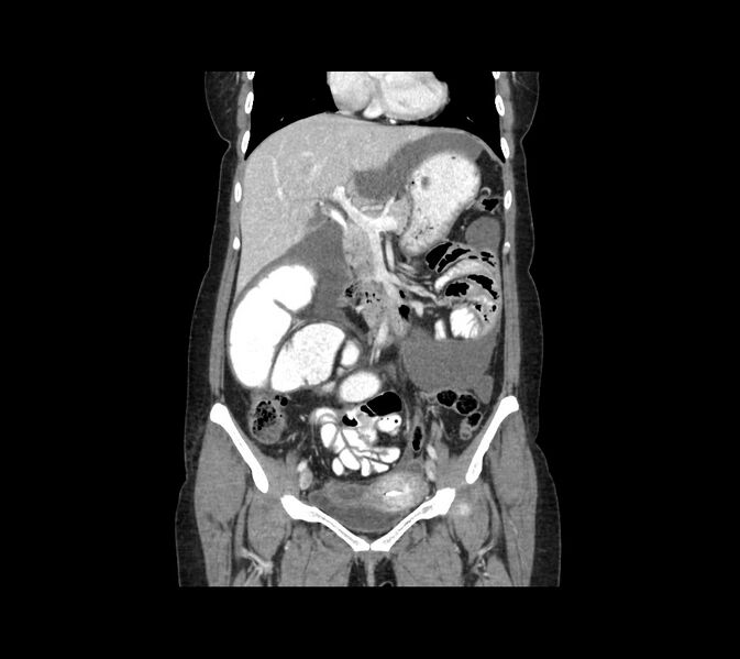 File:Cocoon abdomen with possible tubo-ovarian abscess (Radiopaedia 46235-50636 B 23).jpg