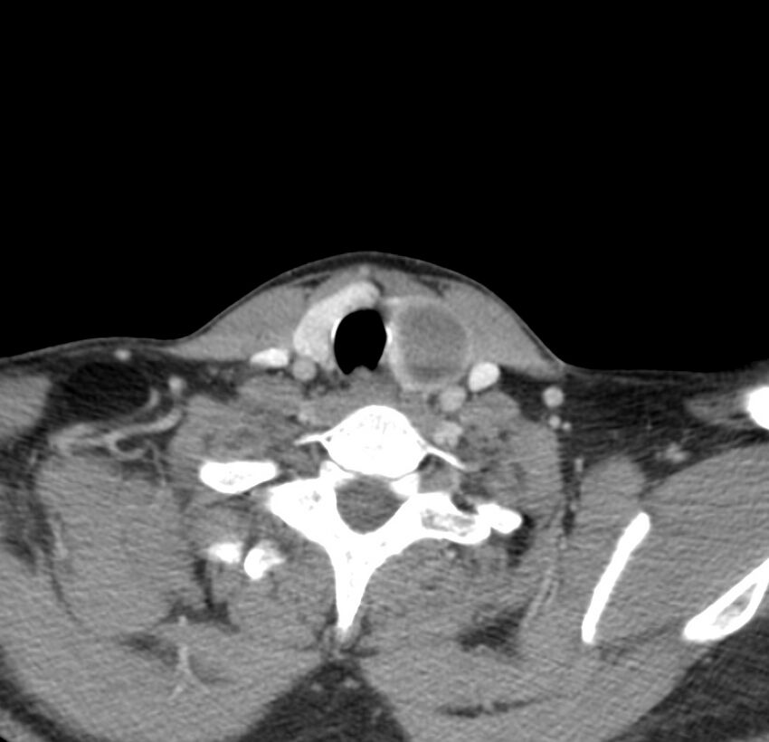 Colloid cyst of thyroid (Radiopaedia 22897-22923 Axial C+ delayed 61).jpg