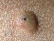 Epidermal cyst with a central poor