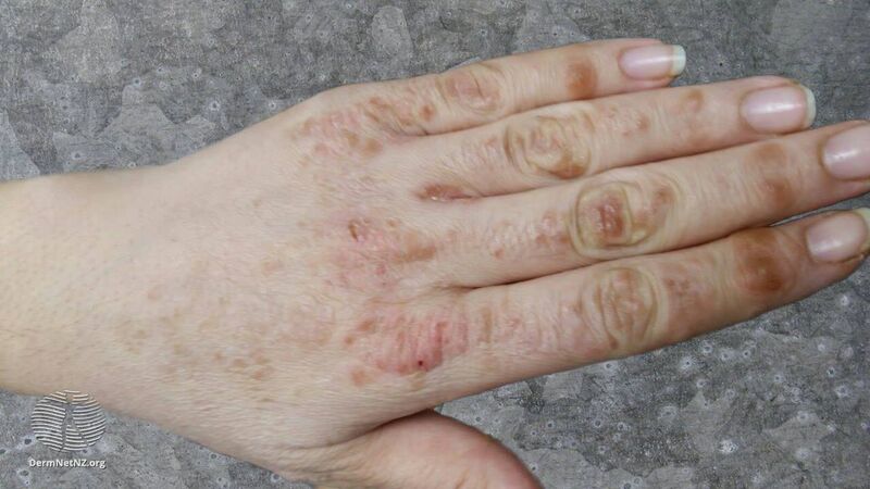 File:Hand-foot syndrome due to sorafenib (DermNet NZ HFS-4).jpg