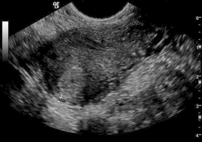 File:Interstitial ectopic pregnancy (Radiopaedia 36010).png