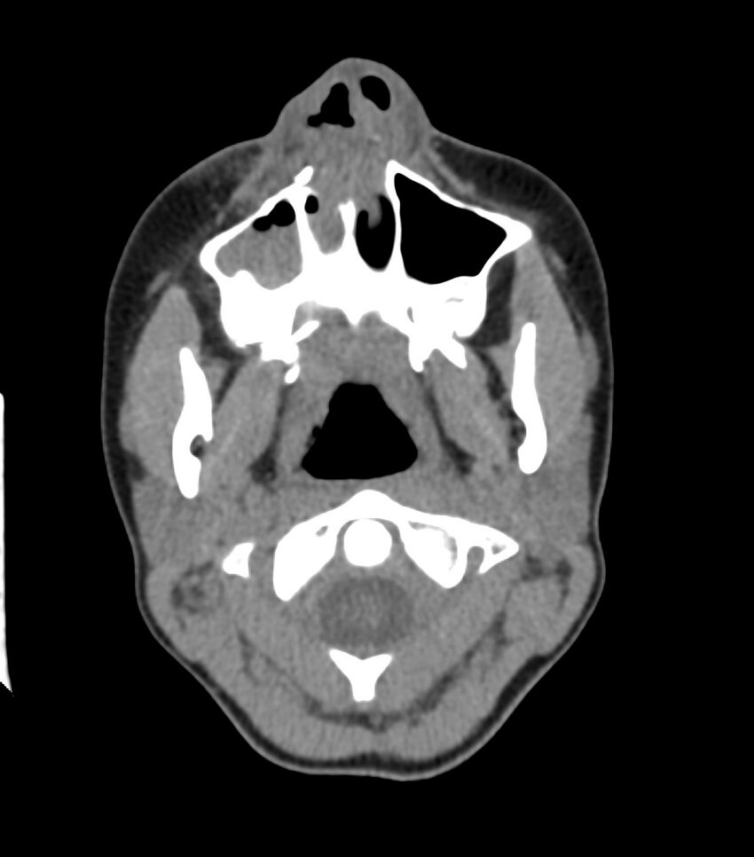 Nasoorbitoethmoid fracture (Radiopaedia 90044-107205 Axial non-contrast 106).jpg