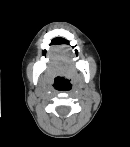 File:Nasoorbitoethmoid fracture (Radiopaedia 90044-107205 Axial non-contrast 76).jpg