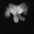 Necrotizing epididymo-orchitis with intra-testicular abscess (Radiopaedia 29397-29860 Coronal T1 C+ 4).jpg
