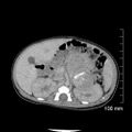 Neonatal neuroblastoma (Radiopaedia 56651-63438 Axial non-contrast 33).jpg