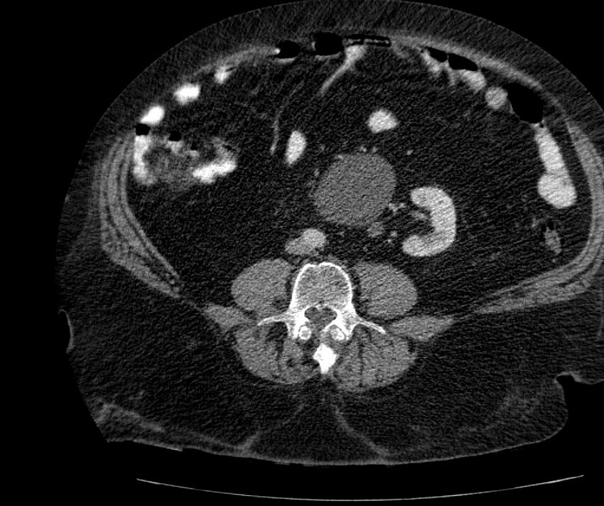 Nephroptosis with inguinal hernia containing perirenal fat (Radiopaedia 56632-63391 C 208).jpg