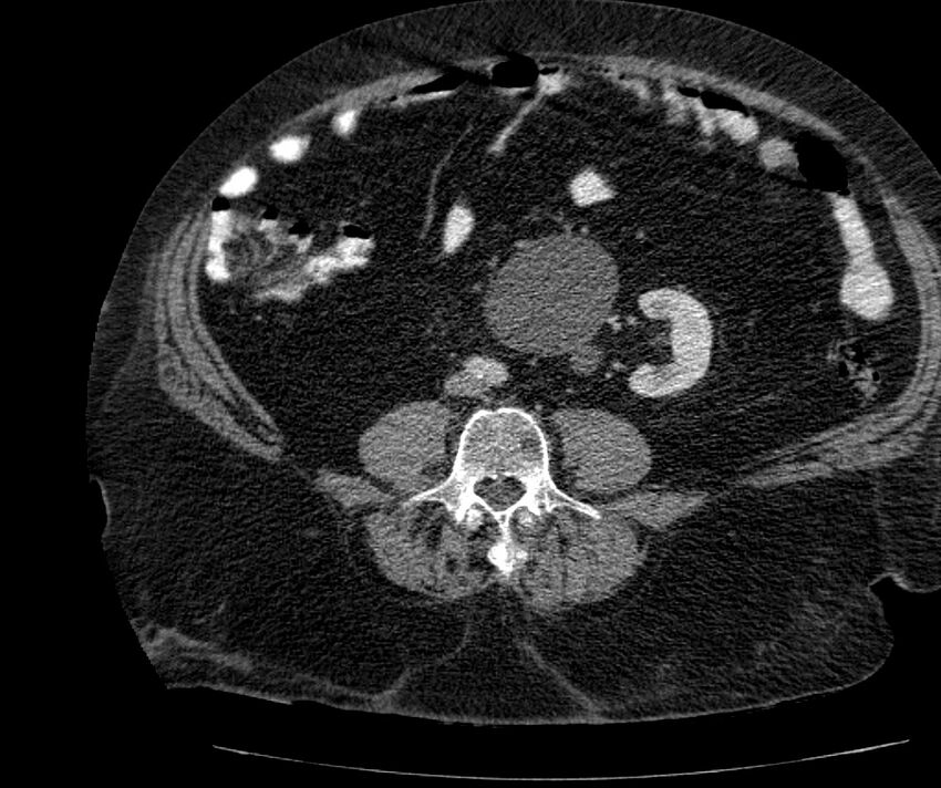Nephroptosis with inguinal hernia containing perirenal fat (Radiopaedia 56632-63391 C 210).jpg