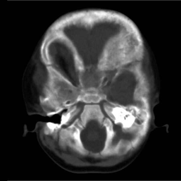File:Neuroblastoma with skull metastases (Radiopaedia 30326-30958 Axial bone window 2).jpg