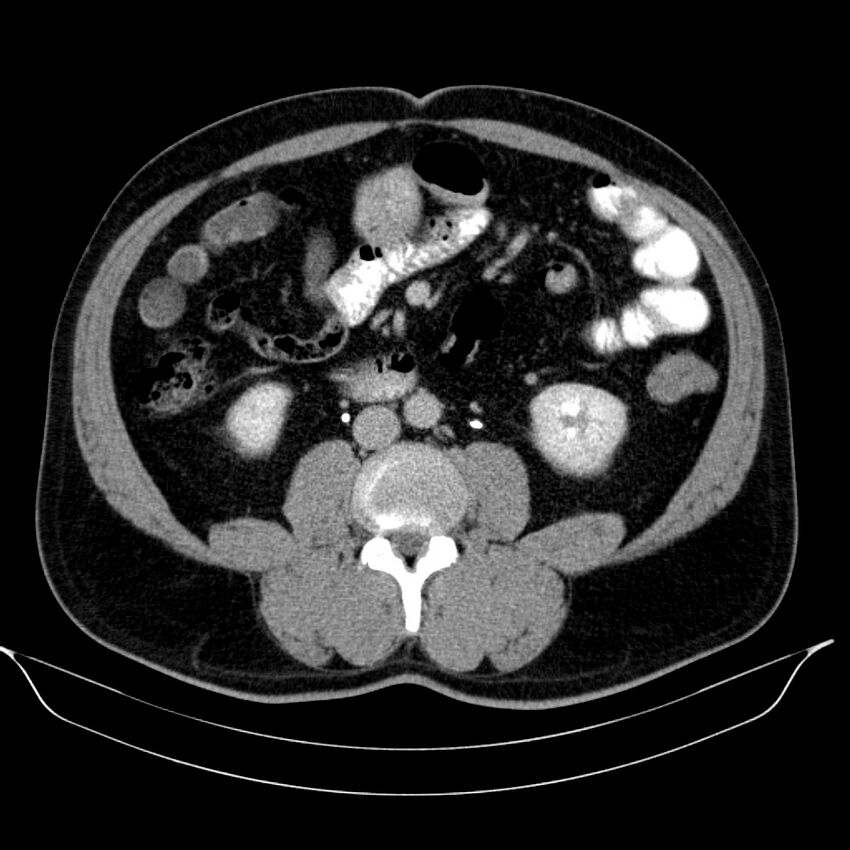 Neuroendocrine tumor of head of pancreas (Radiopaedia 57538-64502 D 46).jpg