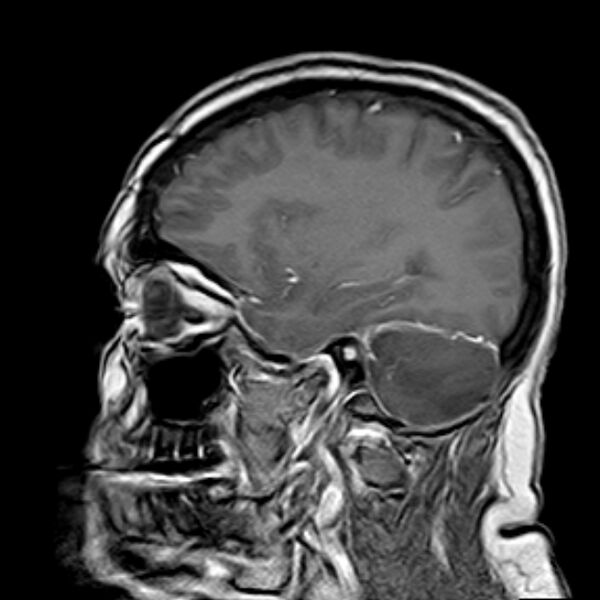 File:Neurofibromatosis type 2 (Radiopaedia 67470-76871 Sagittal T1 C+ 13).jpg