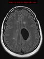 Neuroglial cyst (Radiopaedia 10713-11184 Axial FLAIR 8).jpg