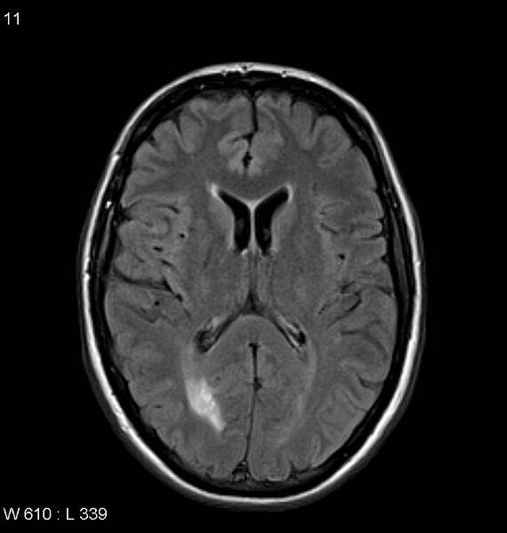 File:Neurosarcoidosis (Radiopaedia 10930-11351 Axial FLAIR 11).jpg