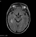 Neurosarcoidosis (Radiopaedia 10930-17204 Axial FLAIR 8).jpg