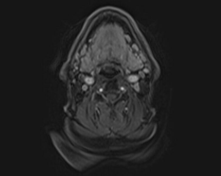 File:Non-Hodgkin lymphoma - parotid gland (Radiopaedia 71531-81890 E 29).jpg