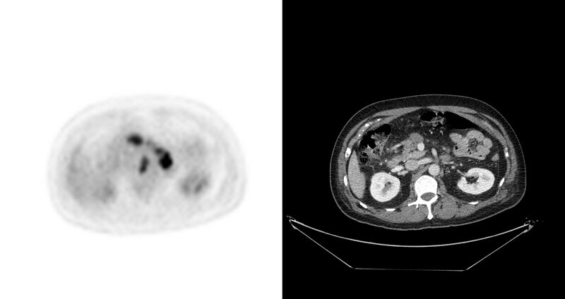 File:Non-Hodgkin lymphoma involving seminal vesicles with development of interstitial pneumonitis during Rituximab therapy (Radiopaedia 32703-33675 axial PET CT 31).jpg