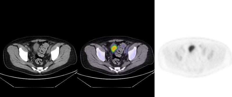 File:Non-Hodgkin lymphoma involving seminal vesicles with development of interstitial pneumonitis during Rituximab therapy (Radiopaedia 32703-33752 ax CT Fus PET 57).jpg