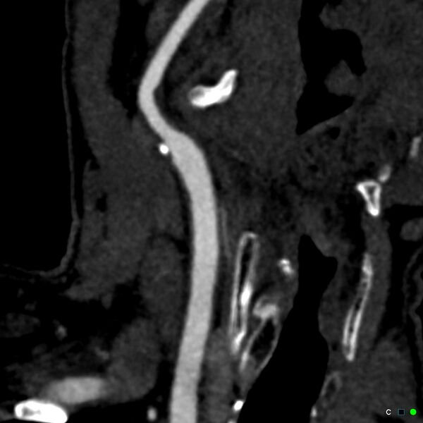 File:Non-occlusive intraluminal internal carotid artery thrombus (Radiopaedia 37751-39658 C 31).jpg