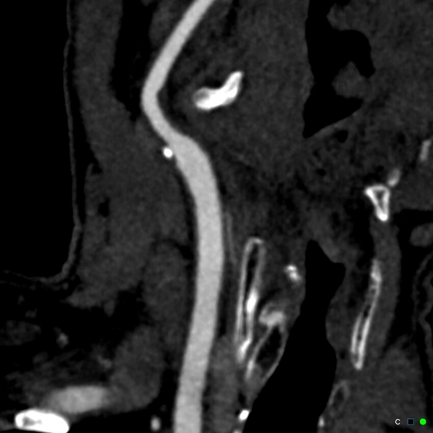 Non-occlusive intraluminal internal carotid artery thrombus (Radiopaedia 37751-39658 C 31).jpg