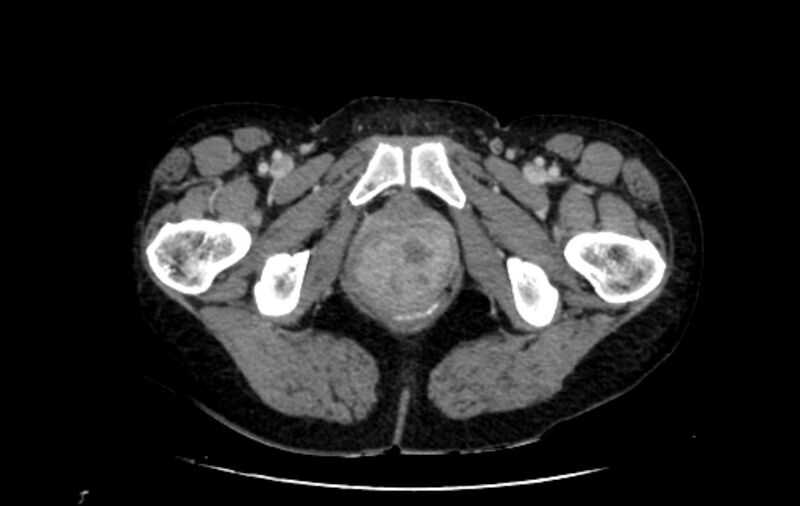 File:Non-puerperal uterine inversion (Radiopaedia 78343-91094 A 91).jpg
