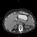 Non Hodgkin lymphoma in a patient with ankylosing spondylitis (Radiopaedia 84323-99624 Axial non-contrast 34).jpg