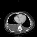 Non Hodgkin lymphoma in a patient with ankylosing spondylitis (Radiopaedia 84323-99624 B 20).jpg
