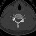 Normal CT of the cervical spine (Radiopaedia 53322-59305 Axial bone window 181).jpg