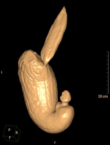 File:Normal CT virtual gastroscopy (Radiopaedia 29960-30501 3D VG 18).jpg