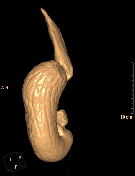 File:Normal CT virtual gastroscopy (Radiopaedia 29960-30501 3D VG 3).jpg