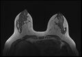 Normal breast MRI - dense breasts (Radiopaedia 80454-93850 Axial T1 85).jpg