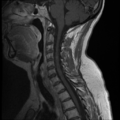 Normal cervical and thoracic spine MRI (Radiopaedia 35630-37156 Sagittal T1 C+ 7).png